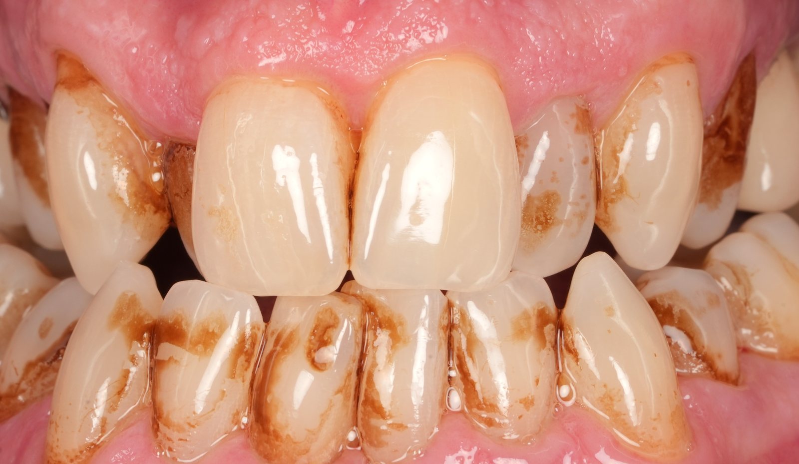 Heavy coffee, tea and tobacco stains on the teeth before EMS Airflow cleaning